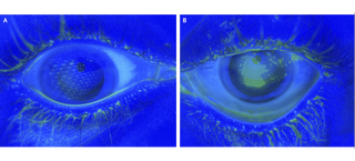 Illustration for article titled The Weird Pattern On this Girl's Eyeball Is From an Airbag